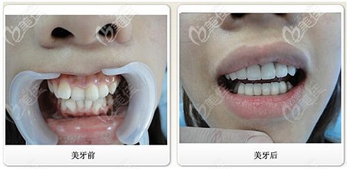 國產(chǎn)金屬自鎖牙齒矯正案例