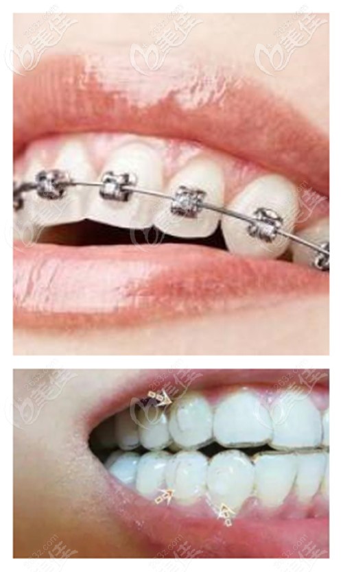 開封優(yōu)尚牙齒矯正價格表