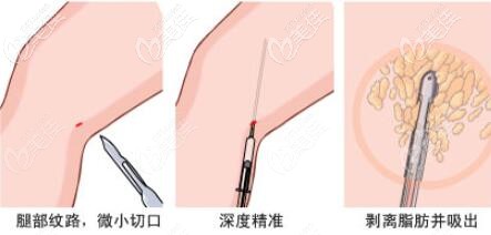 大腿抽脂過(guò)程