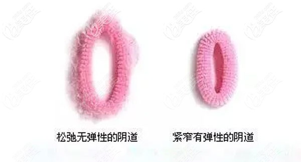 菲蜜麗激光縮陰做一次能收縮一指嗎