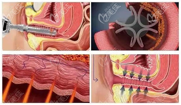 菲蜜麗激光縮陰的三大優(yōu)勢