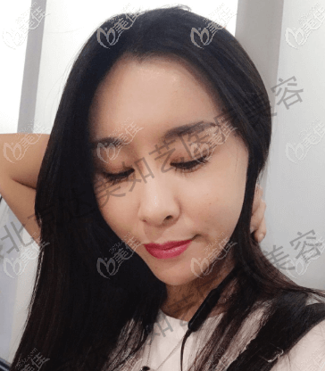 北京谷廷敏醫(yī)生給我做自體脂肪面部填充兩個月效果 北京谷廷敏醫(yī)生給我做自體脂肪面部填充兩個月效果