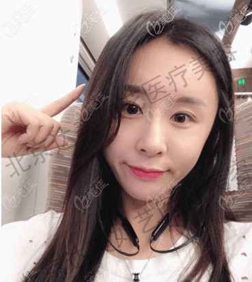 谷廷敏醫(yī)生是從我大腿吸的脂肪填充到全臉的,做完半個月基本消腫