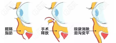 眶隔脂肪釋放手術(shù)過程示意圖