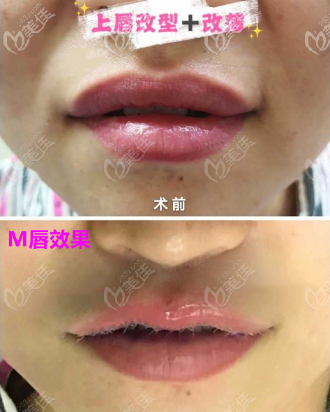 上唇改薄M唇效果圖