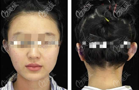 右側(cè)矯正完成效果圖