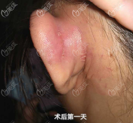 貼發(fā)耳術(shù)后疤痕問(wèn)題展示