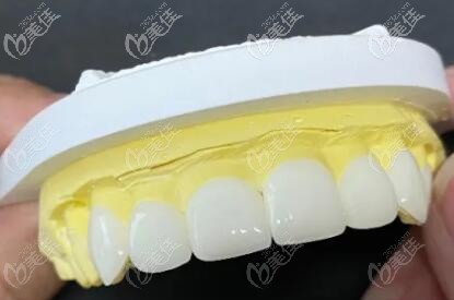 牙齒貼面改善牙齒問題 牙齒貼面改善牙齒問題