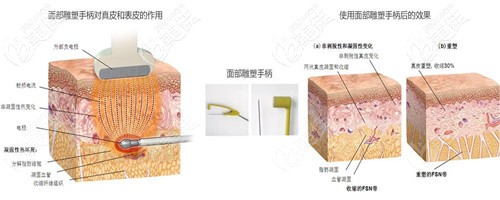 雙下巴做黃金微雕吸脂過程