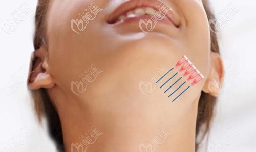 埋線提升下頜緣技術(shù)