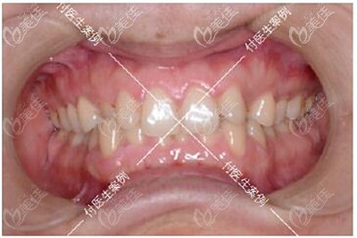 牙齒矯正前深覆合 牙齒矯正前深覆合