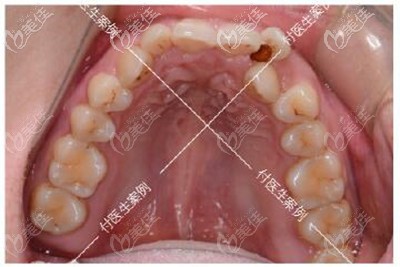 牙齒矯正前上牙效果 牙齒矯正前上牙效果