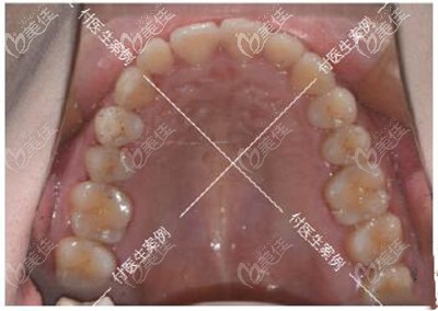 深覆合,露齦笑戴3M金屬自鎖托槽矯正后,都說(shuō)我像去做了墊下巴