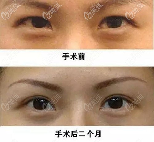 高亮全切雙眼皮案例 高亮全切雙眼皮案例