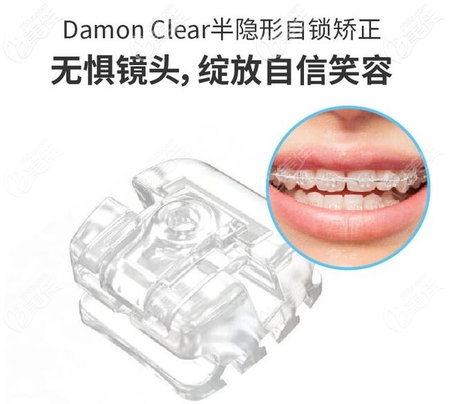 半隱形托槽矯正托槽示意圖