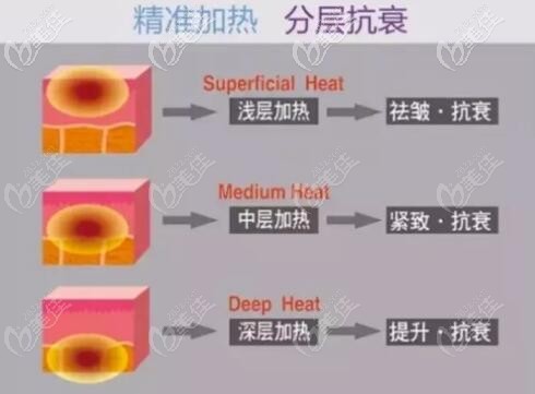 熱拉提分層加熱抗衰示意圖