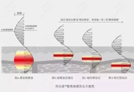 熱拉提射頻發(fā)射示意圖