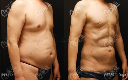 韓國(guó)麗迪安5D腰腹吸脂真人照片 韓國(guó)麗迪安5D腰腹吸脂真人照片