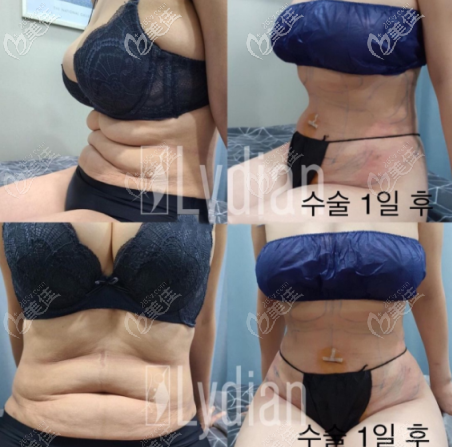 安敬天5D脂肪雕刻術(shù)實(shí)例圖 安敬天5D脂肪雕刻術(shù)實(shí)例圖