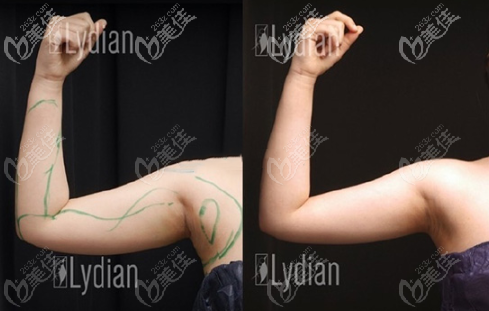 韓國(guó)麗迪安手臂吸脂實(shí)例圖 韓國(guó)麗迪安手臂吸脂實(shí)例圖