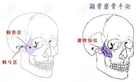 吳昌鉉面部輪廓整形 吳昌鉉面部輪廓整形