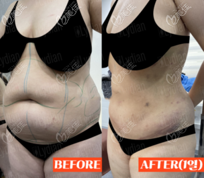 安敬天院長(zhǎng)腰腹吸脂案例圖 安敬天院長(zhǎng)腰腹吸脂案例圖