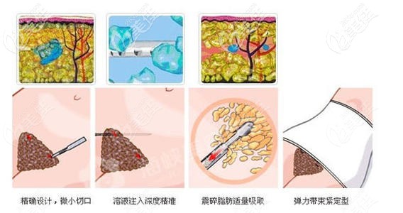 康美整形做腰腹環(huán)吸手術(shù)