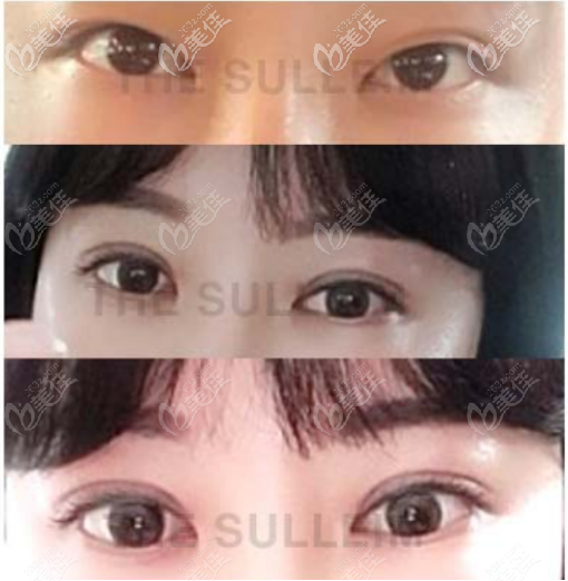 韓國Sulleim心動(dòng)整形醫(yī)院雙眼皮整形案例一 韓國Sulleim心動(dòng)整形醫(yī)院雙眼皮整形案例一