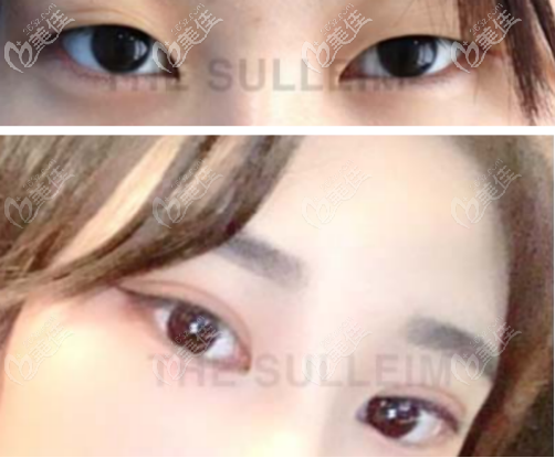 韓國(guó)Sulleim心動(dòng)整形醫(yī)院做雙眼皮手術(shù)怎么樣？用幾組案例來(lái)證明