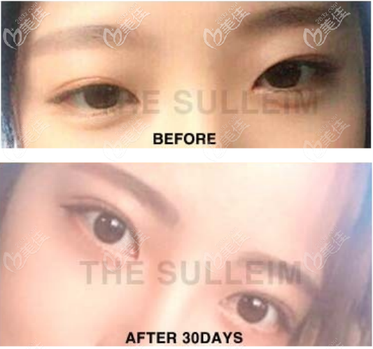 韓國Sulleim心動(dòng)整形醫(yī)院雙眼皮整形案例四 韓國Sulleim心動(dòng)整形醫(yī)院雙眼皮整形案例四