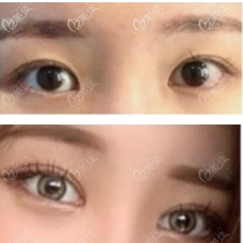 韓國Sulleim心動(dòng)整形醫(yī)院雙眼皮整形案例五 韓國Sulleim心動(dòng)整形醫(yī)院雙眼皮整形案例五