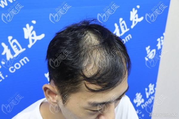 頭頂稀疏加密植發(fā)前 頭頂稀疏加密植發(fā)前