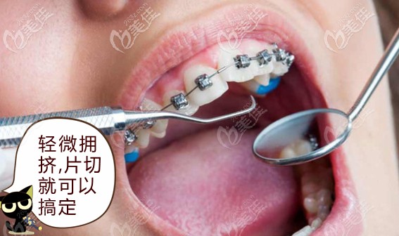 輕度擁擠做片切就可以排齊