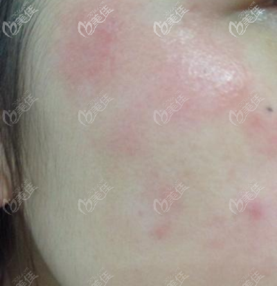 皮膚過(guò)敏癥狀