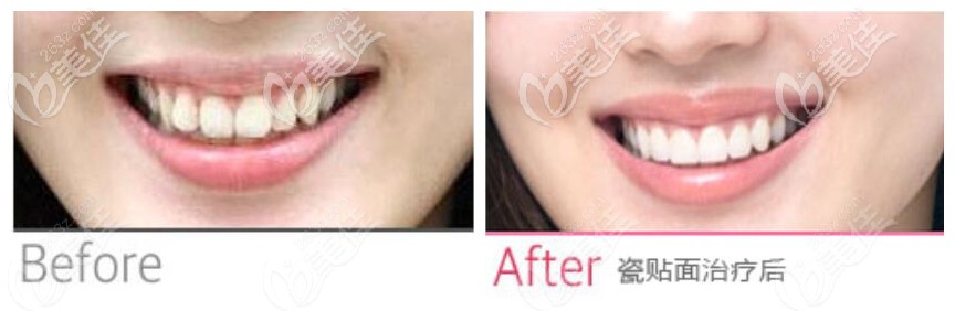 這有韓國(guó)橡樹(shù)牙科做上半口8顆超薄牙貼面美白牙齒效果圖，前后對(duì)比效果……