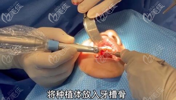 韓國古德萊芙口腔種植一顆前門牙的過程 韓國古德萊芙口腔種植一顆前門牙的過程