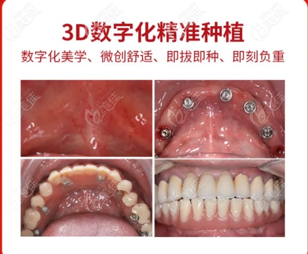 廈門登特口腔進口種植牙多少錢一顆?5折起 廈門登特口腔進口種植牙多少錢一顆?5折起