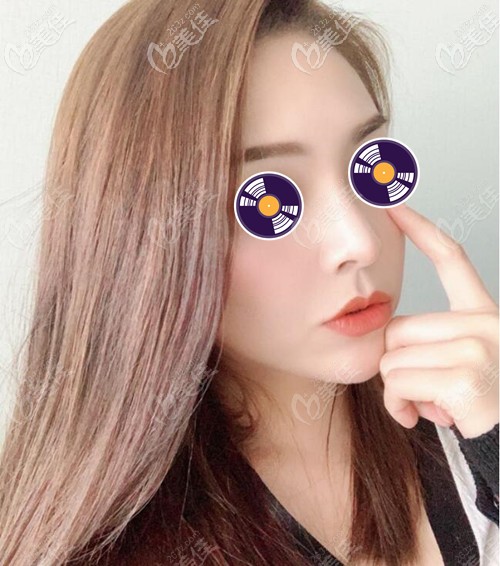 沈紹勇鼻綜合術(shù)后效果 沈紹勇鼻綜合術(shù)后效果