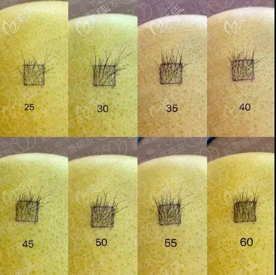 植發(fā)一平方厘米是多少株頭發(fā)