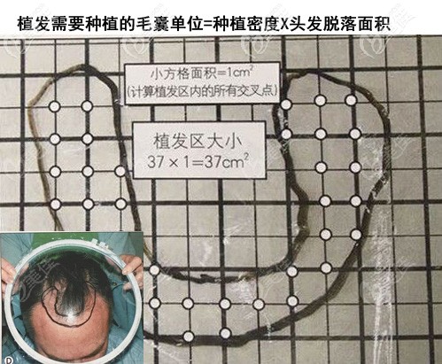 植發(fā)一平方厘米多少錢的計算方式