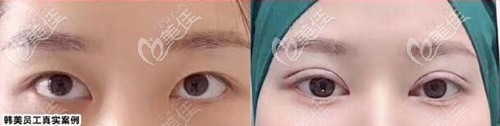 瀘州韓美雙眼皮案例