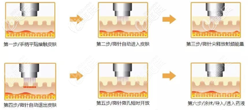 黃金微針治療原理 黃金微針治療原理