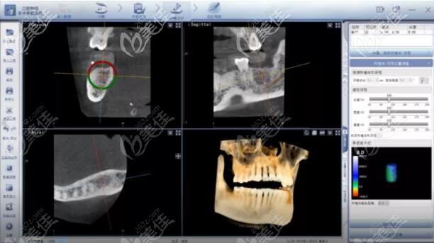 全程監(jiān)控種植位點(diǎn)、角度、深度