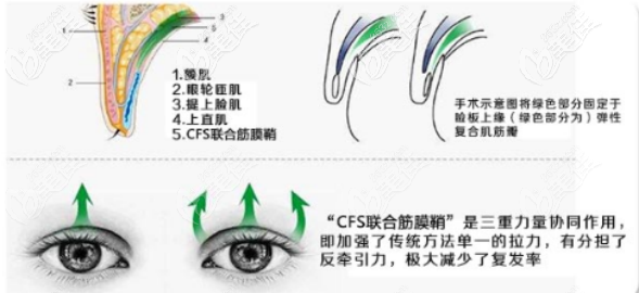 CFS聯(lián)合筋膜翹鞘 CFS聯(lián)合筋膜翹鞘