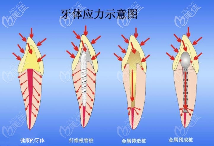 不同樁核材料修復(fù)后牙體應(yīng)力示意圖