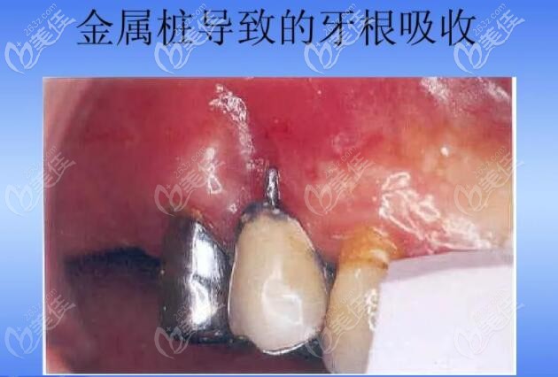 金屬樁導(dǎo)致牙根吸收的照片