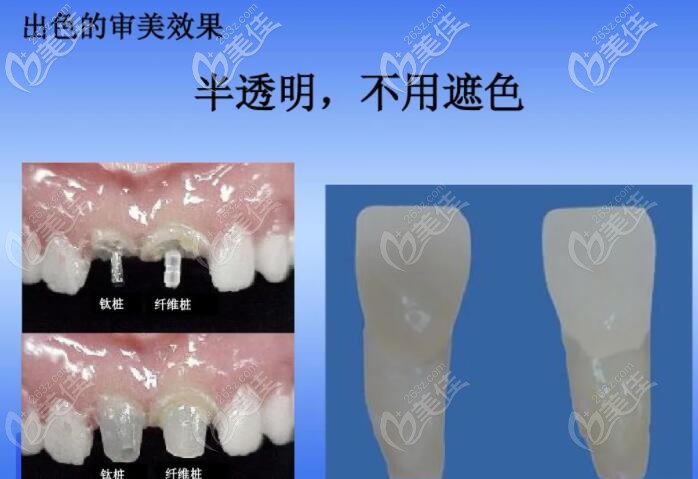 纖維樁修復(fù)的美學(xué)效果圖