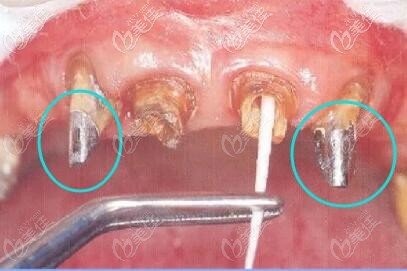 金屬樁修復(fù)后的樣子