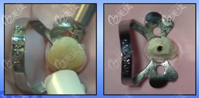 采用纖維樁修復(fù)很容易去除