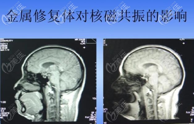 金屬樁很容易影響核磁共振
